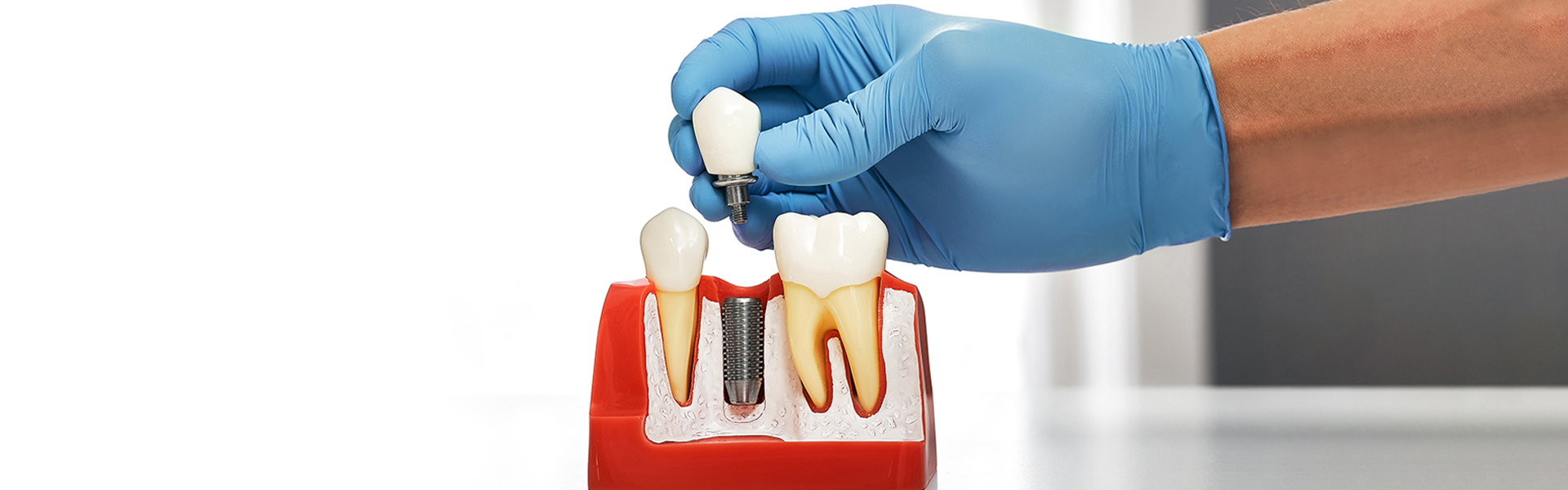 Understanding the Role of Implant Abutments in a Confident Smile